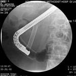 ERCP Biliary Pancreatic Stenting